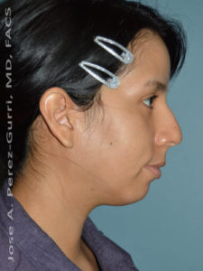 before right side view chin augmentation of female patient 2501