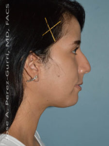 after right side view chin augmentation of female patient 2501