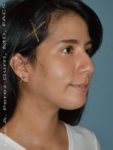 after right angle view chin augmentation of female patient 2501