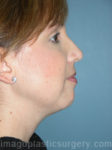 before right side view chin augmentation of female patient 2506