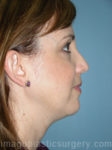 after right side view chin augmentation of female patient 2506