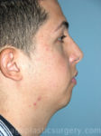 before right side view chin augmentation of male patient 2511
