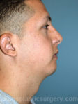 after right side view chin augmentation of male patient 2511
