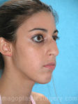 before right side view chin augmentation of female patient 2516