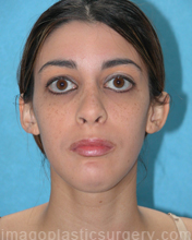 after front view chin augmentation of female patient 2516
