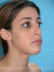 after right side view chin augmentation of female patient 2516