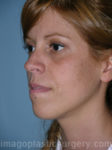 before left angle view chin augmentation of female patient 2521