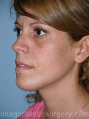 after left angle view chin augmentation of female patient 2521