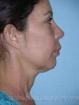 before right side view chin augmentation of female patient 2532