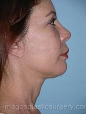 after right side view chin augmentation of female patient 2532