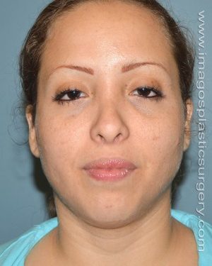 before front view chin augmentation of female patient 2543