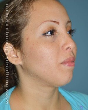 before right angle view chin augmentation of female patient 2543