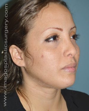 after right angle view chin augmentation of female patient 2543