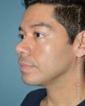after left angle view chin augmentation of male patient 2548
