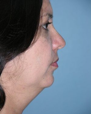 before right side view chin augmentation of female patient 2553