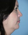 after right side view chin augmentation of female patient 2553