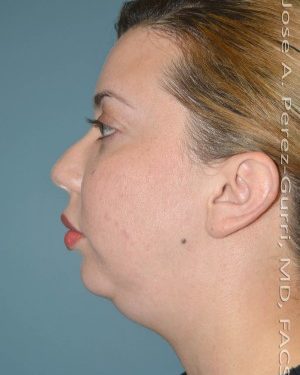 before right side view chin augmentation of female patient 2566