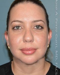 after front view chin augmentation of female patient 2566