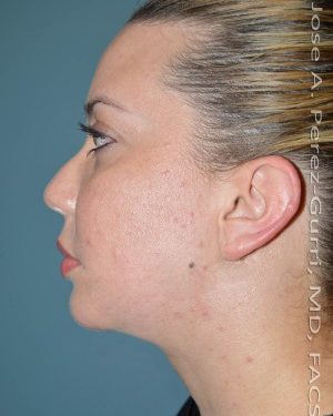after right side view chin augmentation of female patient 2566
