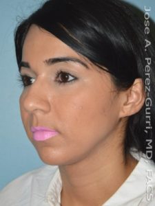 before left angle view chin augmentation of female patient 2571