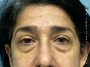 before front view eyelid surgery of female patient 3221