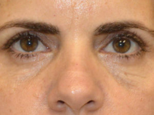 after front view eyelid surgery of female patient 3224