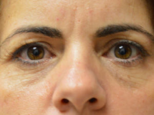 before front view eyelid surgery of female patient 3224