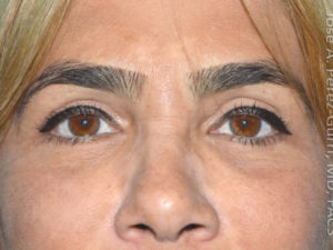 after front view eyelid surgery of female patient 3227