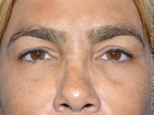 before front view eyelid surgery of female patient 3227