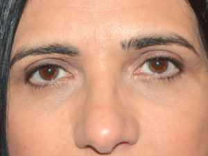 after front view eyelid surgery of female patient 3231