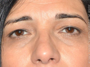 before front view eyelid surgery of female patient 3231