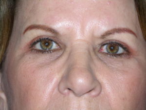 after front view eyelid surgery of female patient 3236