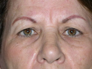 before front view eyelid surgery of female patient 3236