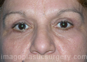 after front view eyelid surgery of female patient 3248