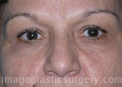 before front view eyelid surgery of female patient 3248