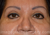 after front view eyelid surgery of female patient 3251