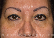 before front view eyelid surgery of female patient 3251