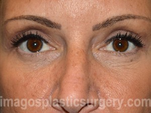 after front view eyelid surgery of female patient 3254