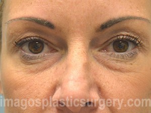 before front view eyelid surgery of female patient 3254