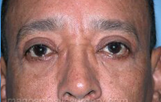 after front view eyelid surgery of male patient 3260