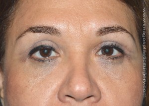 after front view eyelid surgery of female patient 3266