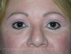 after front view eyelid surgery of female patient 3350