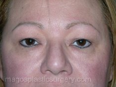 before front view eyelid surgery of female patient 3350