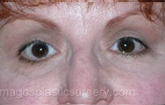 after front view eyelid revision of female patient 3363