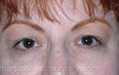 before front view eyelid revision of female patient 3363