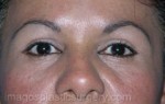 after front view eyelid surgery of female patient 3377