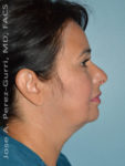 after right side view eyelid surgery of female patient 3480