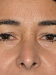 before front view eyelid surgery of female patient 3480