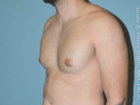 before left angle view gynecomastia of male patient 3267
