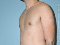 after left angle view gynecomastia of male patient 3267